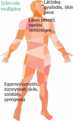 Sclerosis multiplex és fájdalom - fájdalomportákorhatartalanul.hu